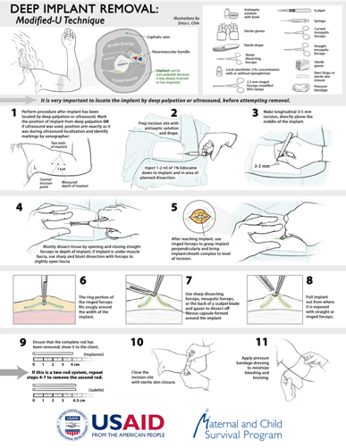 Modified "U-Technique" Infographic