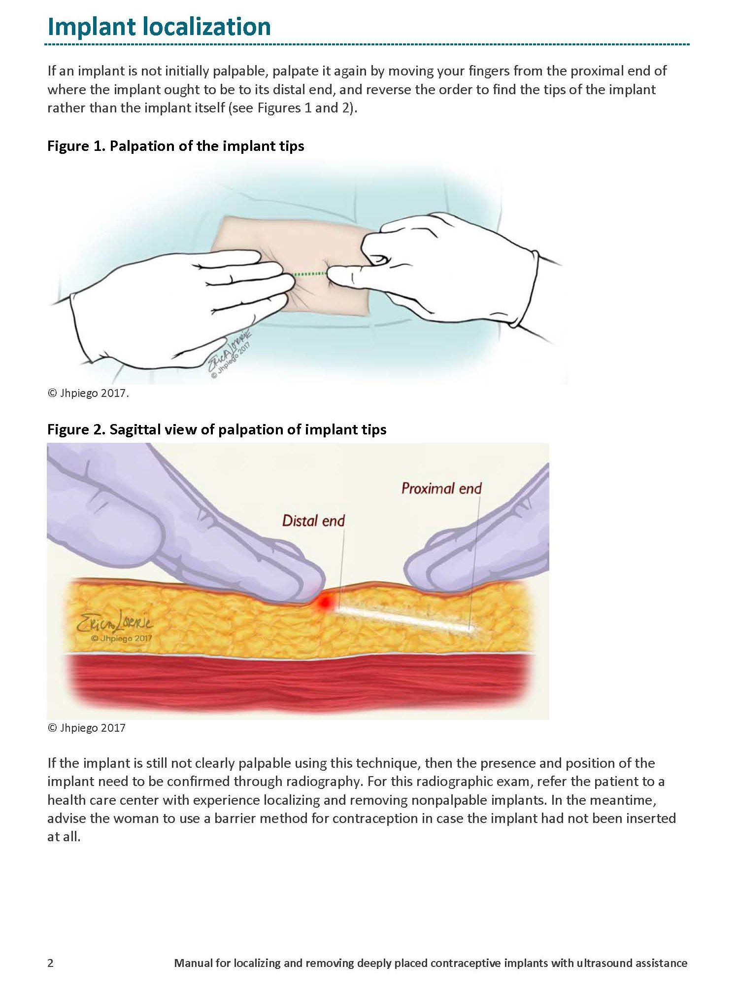 Manual for localizing and removing deeply placed contraceptive implants